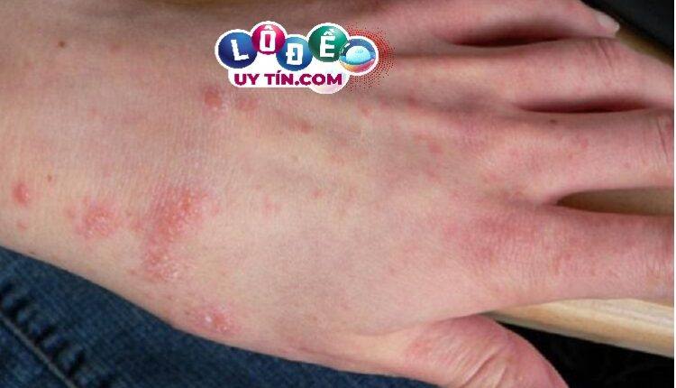 Nằm mơ thấy bị ghẻ lở là điềm gì? Đánh số nào? 3 Nằm mơ thấy bị ghẻ lở là điềm gì? Đánh số nào 1