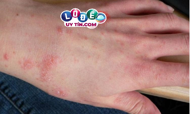Nằm mơ thấy bị ghẻ lở là điềm gì? Đánh số nào?