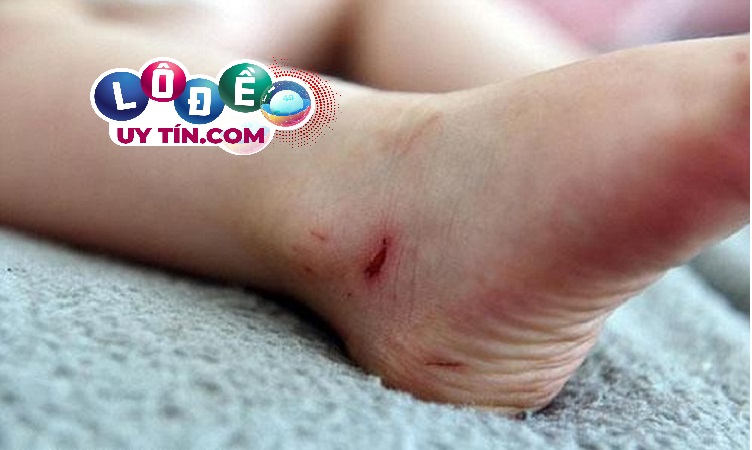 Điềm báo mơ thấy chảy máu chân đánh con gì khi chạy nhanh