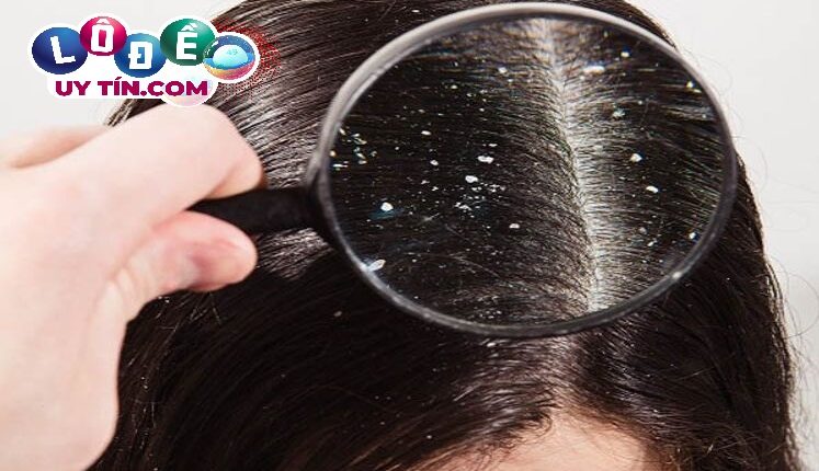 Giải mã giấc mơ thấy đầu có chấy - Số nào may mắn? 2 Giải mã giấc mơ thấy đầu có chấy - Số nào may mắn