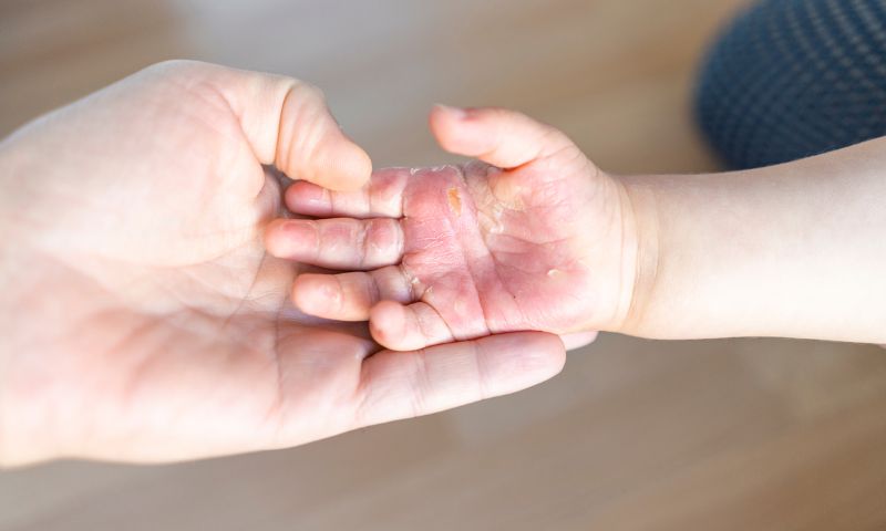 Nằm mơ thấy bị bỏng đánh lô như thế nào cho hợp lý?